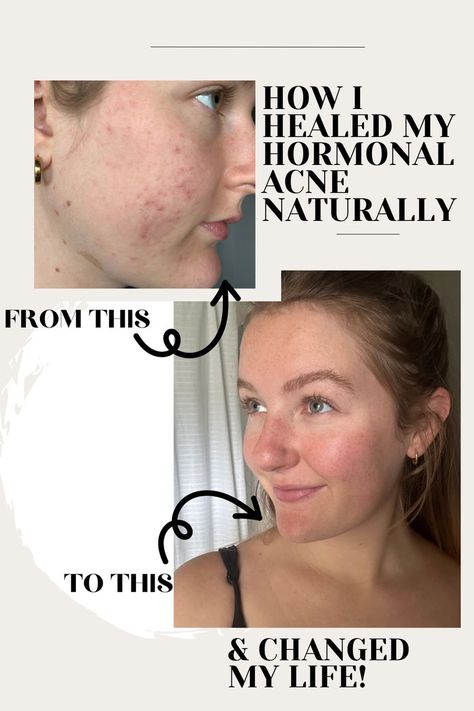 Hormonal acne is not fun at all.. and to be honest, neither is the healing journey. But it is so worth it to learn how to tune into your body, and make necessary changes for your health and life! Healing acne naturally. Coming Off Birth Control, Healthy Skin Routine, Healing Acne, Mild Acne, Healthy Skin Care Routine, Beauty App, Natural Acne, Hormonal Acne, Healthy Skin Tips