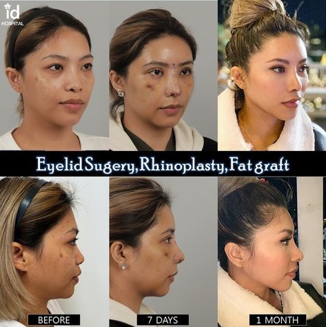 ID Hospital review of an American fashionista Shey - IDHOSPITAL Face Transformation, Korean Plastic Surgery, Face Surgery, Rhinoplasty Before And After, Fat Grafting, Celebrity Plastic Surgery, Korean Face, Double Eyelid, Yoga For Flexibility