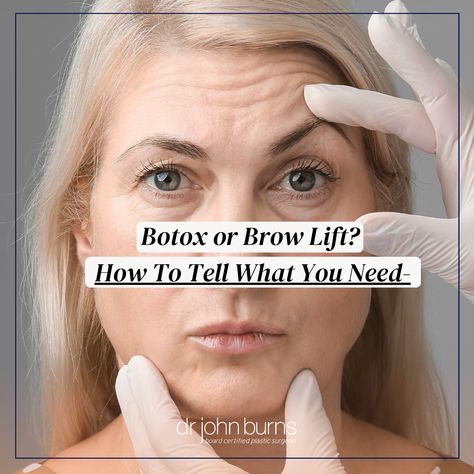 Aging caucasian woman being evaluated by a person in medical gloves while raising her eyebrows Endoscopic Brow Lift, Brow Lift Surgery, Botox Forehead, Uneven Eyebrows, Botox Brow Lift, Forehead Lift, Facial Aging, Types Of Eyebrows, Botox Before And After