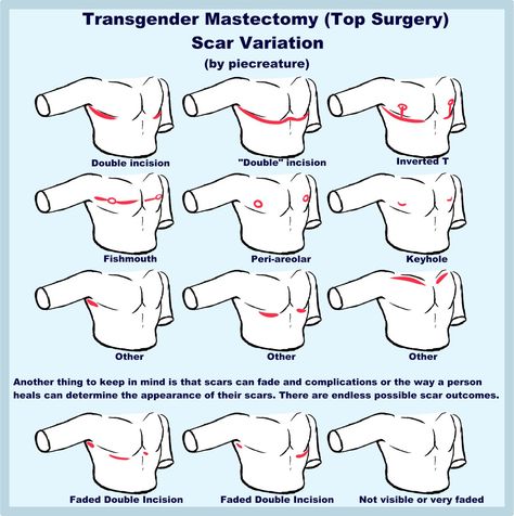 Sylar 🔪 on Twitter: "I usually see people giving their post op trans characters the same "standard" double incision scars. I thought I'd draw up some examples showing that there's tons of different outcomes a person can get from top surgery! They're actually tons of fun to mess around with!!… https://t.co/G1WPgvc7dI" Trans Characters Art, Trans Masc Top Surgery, Trans Dysphoria Drawing, Top Surgery Drawing, Demiboy Art, Trans Drawings Ftm, Trans Masc Art, Trans Top Surgery, Top Surgery Art