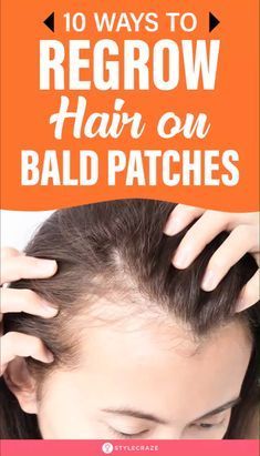 Regrow Hair Naturally, Natural Hair Growth Remedies, Bald Patches, Brown Spots On Face, Hair Remedies For Growth, Home Remedies For Hair, Regrow Hair, Spots On Face, New Hair Growth