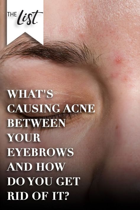 For some, T-zone acne can present itself more so on the forehead or nose. For others, between the eyebrows are a prime target for spots to gather. Obviously, you can pluck, thread, or wax the hair away, but the follicles remain, and so carry the potential of getting clogged. But there must be a way to prevent acne between your eyebrows, right? #acne #skincare #eyebrows #skin Pimples Between Eyebrows, Eyebrow Acne, Acne Between Eyebrows, Get Rid Of Spots, Pimple Causes, Pimples On Forehead, Forehead Acne, Plucking Eyebrows, Acne Skincare