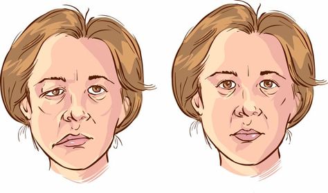 Bell’s Palsy, Muscles Of The Face, Bells Palsy, Facial Nerve, Muscle Weakness, Medical Tourism, Facial Muscles, Alternative Treatments, Reflexology