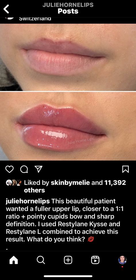 Lip Filler Celebrities, Soft Cupids Bow Lips, Key Hole Lips Injections, Lip Injections Heart Shape, Cupid Bow Lips Filler, M Shape Lip Filler, Lip Blush Natural, Natural Lip Injections Before And After, Full Syringe Lip Filler Before And After