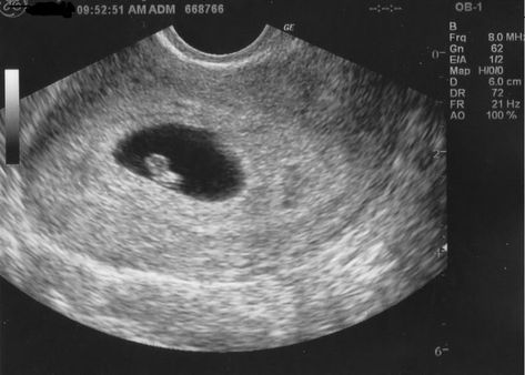 3 Weeks Pregnant Ultrasound, 4 Weeks Pregnant Ultrasound, 6 Weeks Pregnant Ultrasound, Fake Ultrasound, 16 Weeks Pregnant Ultrasound, 3 Weeks Pregnant, 1 Week Pregnant, Baby Ultrasound Pictures, 6 Weeks Pregnant