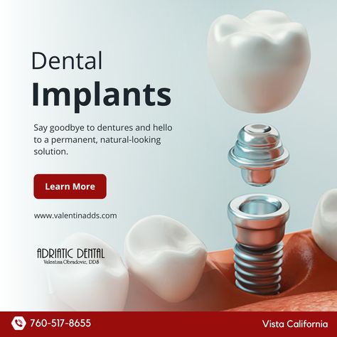 Dental implants look and feel like natural teeth. They are custom-made to match the color, shape, and size of the surrounding teeth, which can improve a person's smile and overall appearance. Call us ☎️ (760) 517-8655 Visit us at 👉🏼 https://buff.ly/3K3bArB #AdriaticDental #ValentinaObradovic #VistaDentist #VistaCA #DentalImplants Dental Clinic Creative Ads, Dentist Creative Ads, Dental Implants Creative Ads, Dental Clinic Ads, Dental Creative Ads, Dental Campaign, Implant Dental, Clove Dental, Dental Post