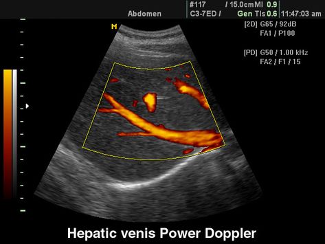 Vessels: Hepatic veins, power doppler. Echogramm №96 was received by the scanner SonoAce-8000. Medical Sonography, Diagnostic Medical Sonography, Ultrasound, Medical