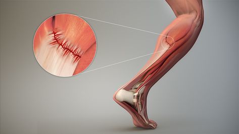 From Wikiwand: Strain (injury) Gastrocnemius Muscle, Calf Strain, Sports Physical Therapy, Calf Cramps, Calf Injury, Muscle Strain, Shoulder Muscles, Muscle Spasms, Muscle Fatigue