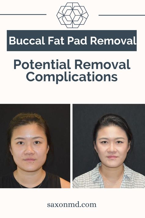 Buccal fat removal is a popular cosmetic procedure that sculpts the face by reducing fat pads in the lower cheeks, leading to a slimmer appearance and enhanced cheekbones. While generally safe, it’s important to be aware of potential risks and complications.

In our latest blog post, we discuss who is a good candidate, what to expect during the procedure, and the importance of aftercare for optimal results.

Click the link to read more and make informed decisions! #buccalfat #buccalfatremoval Buccal Fat Removal, Cheek Fat, Reduce Face Fat, Fat Removal, Cosmetic Procedures, The Face, Blog Post, Need To Know, Blog Posts