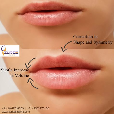 Plumping your pout with fillers is now the most mainstream procedure of all.  Lip augmentation is the cosmetic procedure that can give you fuller, plumper lips. It can also help decrease lines and wrinkles around the lips. Correcting shape and symmetry whilst adding a little volume is what this procedure helps in. It involves the use of injections to increase the size of lips making them look more plumper & poutier. Lip Filler Bottom Lip Bigger, Lip Goals, Lip Job, Brow Lifting, Russian Lips, Plumper Lips, Lipsense Combos, Lips Inspiration, Face Fillers