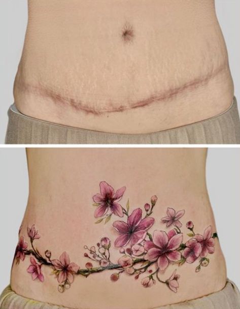 Tattoo Over Large Scar, Abdomen Scar Tattoo Cover Up, Gallbladder Scar Tattoo Cover Up, Belly Side Tattoo, Mastectomy Tattoo Flat, Strechmark Tatoos, Post Mastectomy Tattoo, Breast Lift Tattoo Cover Up, Arm Lift Scar Tattoo Cover Up