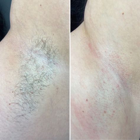 Skin Laser Before And After, Waxing Content, How To Lighten Underarms, Esthetician Posts, Rid Of Dark Underarms, Underarm Waxing, Waxing Services, Dark Underarms, Sugar Waxing