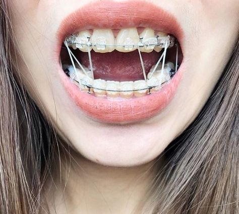 Soul Aesthetics, Braces Girl, Lip Reference, Braces Retainer, Ceramic Braces, Cute Braces Colors, Braces Elastics, Adult Braces, Getting Braces