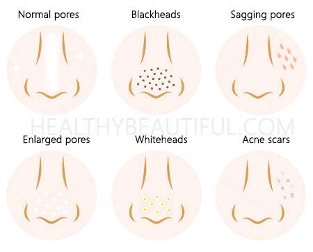 Clogged Pores On Nose, How To Close Pores, Clean Nose Pores, Make Pores Smaller, Foot Detox Soak, Deep Clean Skin, Big Pores, Nose Pores, Deep Clean Pores