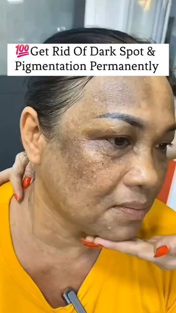 How To Clear Dark Spots On Face Overnight, How To Remove Dead Skin, Best Dark Spot Remover For Face, Black Spots On Face Remove Fast, How To Remove Dark Spots On Face, Remove Pigmentation From Face, Face Dark Spot Remover, Pigmentation On Face, Skin Care For Dark Spots