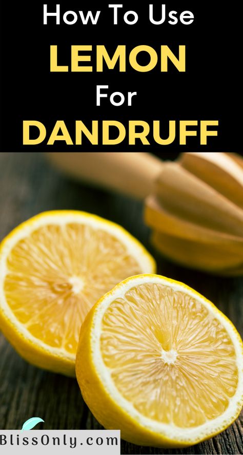 Home Remedy For Dandruff How To Get Rid, Ways To Get Rid Of Dandruff, How To Get Rid Of Itchy Scalp, Lemon For Dandruff, Lemon For Hair, Dandruff Home Remedies, Remedies For Dry Mouth, Home Remedies For Dandruff, Home Remedies For Allergies