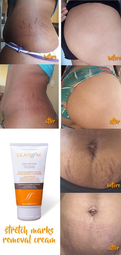 Stretch Mark Removal Cream, Strech Marks, Marks Cream, Lotion For Oily Skin, Stretch Mark Cream, Stretch Mark Removal, Rose Purple, Baking Soda Shampoo, Moisturizer For Oily Skin