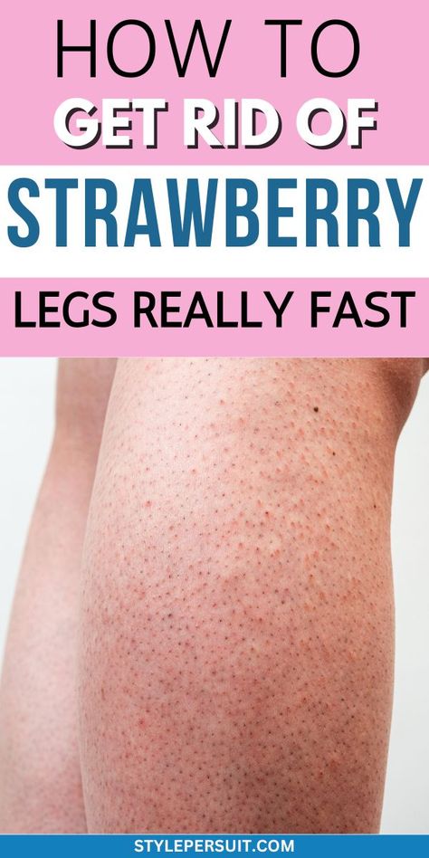 How to Get Rid of Strawberry Legs Fast Bumps On Legs, Exfoliate Legs, Remedies For Dark Lips, Strawberry Legs, Fresh Aloe Vera, Shaving Tips, Keratosis Pilaris, Skin Condition, Beauty Remedies