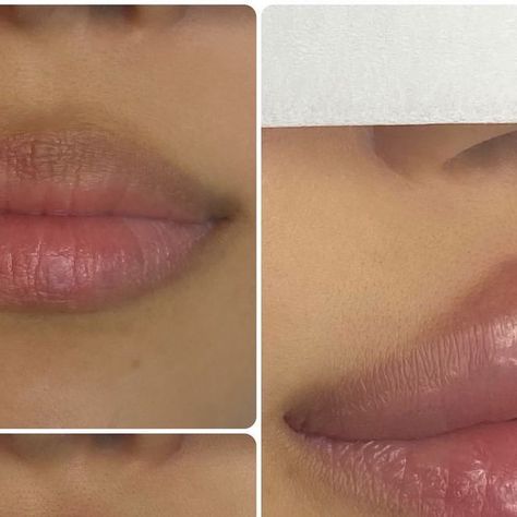 Reveuse Aesthetics on Instagram: "Our signature Lip Augmentation procedure with Hyaluronic acid.

———————————————————————————

CLINIC 📍LONDON CENTRAL - OXFORD STREET 

———————————————————————————

APPOINTMENTS AVAILABLE 
DM for Information, Consultation & Bookings 

———————————————————————————

✔️Advanced Injecting Techniques ✔️Immediately after procedure ✔️Creating Beauty✔️Lifted & Defined ✔️Shape & Volume 
✔️ Pretty & Feminine ✔️Deep Moisturising ✔️Size may reduce by up to 40% during the healing process ✔️1-3 procedures may be required to achieve even the most natural result ✔️Lasting 4 - 12 months
✔️Best results achieved on lips with no previous /minimal filler

———————————————————————————

CLINIC 📍LONDON CENTRAL - OXFORD STREET 

Nearest Tube Stations are on Oxford St:
Marble Arch 
B London Central, Lip Augmentation, Marble Arch, Tube Station, Appointments Available, Oxford Street, Healing Process, Hyaluronic Acid, 12 Months