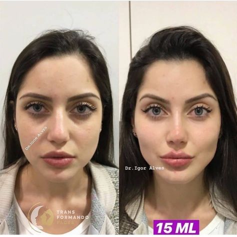 Cosmetic Insider’s Instagram profile post: “Before/after non surgical facial rejuvenation with 15 mLs. What do you think? Comment ⬇️ . . This work was done by @igoorcostalves . . This…” Nose Fillers, Botox Brow Lift, Under Eye Fillers, Face Fillers, Eyebrow Lift, Botox Cosmetic, Botox Face, Cheek Fillers, Facial Fillers