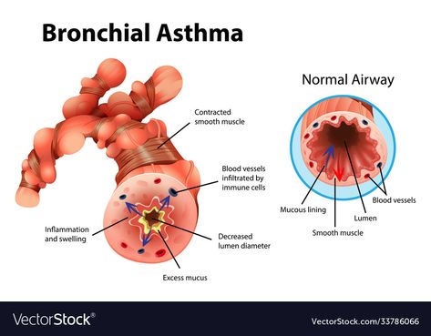 Asthma Illustration, Parathyroid Gland, Bronchial Asthma, Medical Education, Heart Logo, Blood Vessels, Business Names, Anatomy, Adobe Illustrator