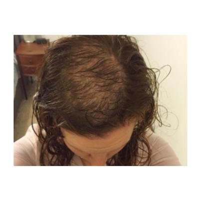 As a scalp specialist, I've... - Women's Health & Lifestyle Trichotillomania Hairstyles, Bedhead Hairstyle, Bald Spots Women, Bald Patches, Mint Hair, Bald Spot, Bald Hair, Hair Pulling, Grow Hair Faster