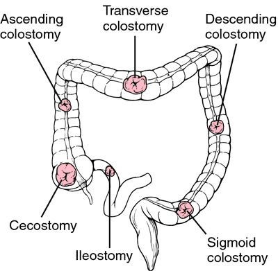 stoma - definition of stoma in the Medical dictionary - by the Free Online Medical Dictionary, Thesaurus and Encyclopedia. Endoscopy Nursing, Surg Tech, Nursing Information, Medical Dictionary, Nursing School Motivation, Nurse Study Notes, Nursing Student Tips, Surgical Nursing, Surgical Tech