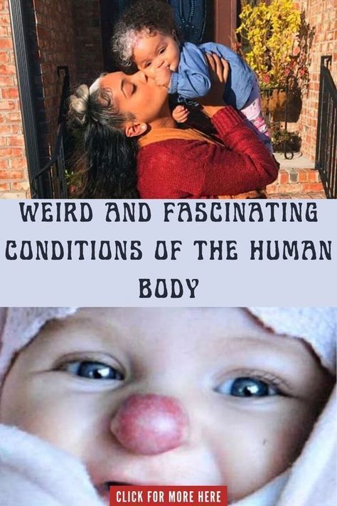 Weird and Fascinating Conditions of the Human Body Kueez Pins, Body Condition, Human Condition, The Human Body, Viral Trend, Skin Conditions, Study Motivation, Viral Pins, Old Hollywood