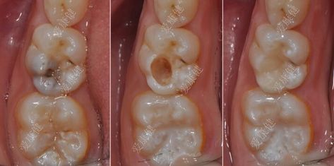 If your filling falls out your tooth can you just leave it? For treating cavities most patients choose a filling, however when a filling falls out most patients ask what’s the best way to treat it? Is it best just to leave it? Root Canal Procedure, Dental Notes, Perfect Smile Teeth, Cavity Filling, Dental Education, Tooth Filling, Braces Tips, Wisdom Tooth Extraction, Gum Inflammation