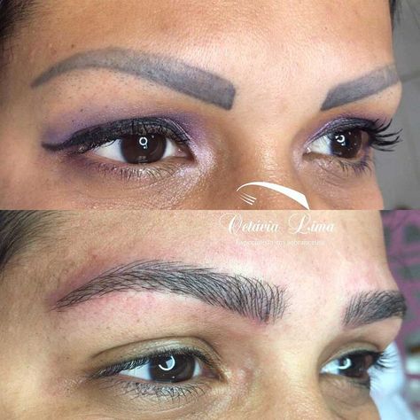 Laser Tattoo Removal Eyebrows, Remove Eyebrow Tattoo, Brow Tattoo Eyebrows, Eye Brows Tattoo Eyebrows, Eyebrow Tattoo Ideas, Bad Eyebrow Tattoo, Eye Brow Tattoo, Tattooed Eyebrows, Cosmetic Tattoo Eyebrows