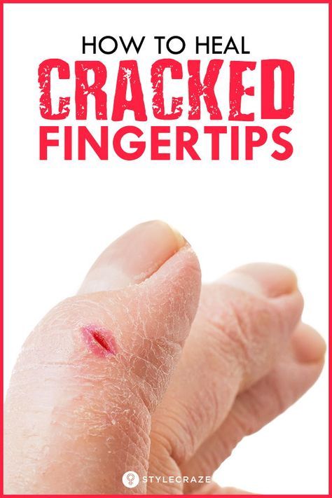 Dry Cracked Hands Remedy, Cracked Hands Remedy, Cracked Fingertips, Dry Hands Remedy, Cracked Fingers, Warts On Face, Sore Hands, Dry Cracked Hands, Cracked Hands