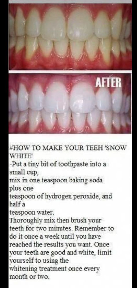 Make Teeth Whiter, Baking Soda Teeth, Obličejové Masky, Natural Teeth Whitening Diy, Baking Soda Teeth Whitening, Nyttige Tips, Teeth Whitening Homemade, Baking Soda And Lemon, Teeth Whitening Remedies