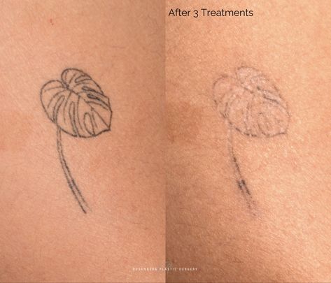 Tattoo removal Laser Tattoo, Laser Tattoo Removal, After 3, Tattoo Removal, A Tattoo, All Skin Types, Skin Types, The Past, Tattoos