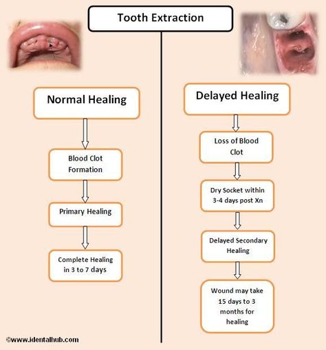 Dental Activities, Wisdom Teeth Food, Teeth Extraction, Tooth Extraction Aftercare, Dental Pictures, Tooth Extraction Healing, Dental Assistant Study, Dental Quotes, Dental Extraction