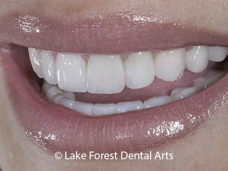 Porcelain Crown Front Teeth, Front Teeth Crowns Before And After, Pretty Crowns, Crown Teeth, Teeth Crown, Prosthetic Teeth, Teeth Aesthetic, Porcelain Crowns, Tooth Crown