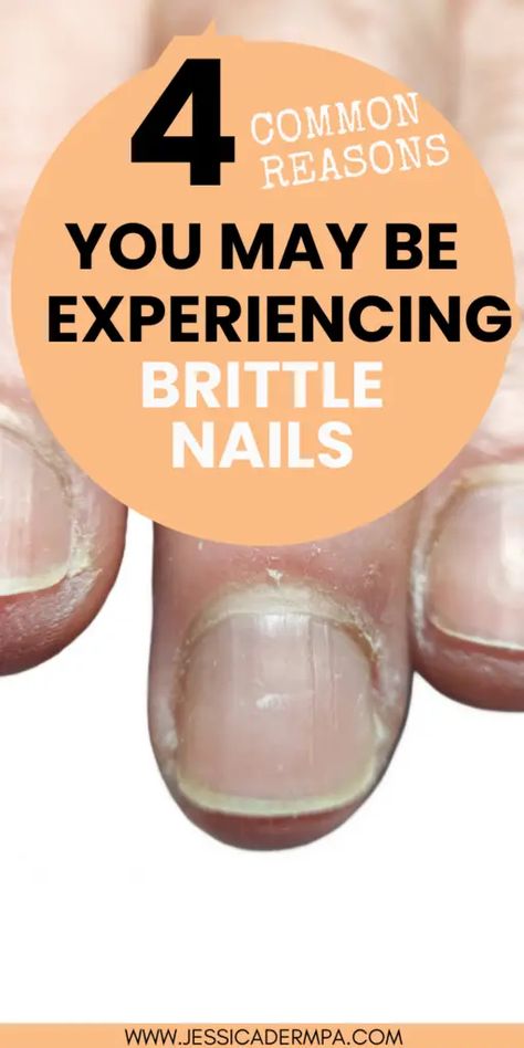 If your nails are breaking easily and you don't know why then read more to learn about potential causes and skin care solutions to strengthen your nails. Brittle Nails Causes, Ways To Strengthen Nails, Dents In Nails, Nail Bed Damage, Fingernail Care, Bumpy Nails, Dermatology Physician Assistant, Nail Disorders, Nail Ridges