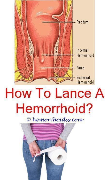 How do I get rid of hemorrhoids in 48 hours? hemorrhoids cream hemorrhoids review what causes hemorrhoids hemorrhoids aafp popped hemorrhoids do hemorrhoids go away hemorrhoids surgery natural recipes for hemorrhoids Thrombosed Hemorrhoid, Hemorrhoid Remedies, Preparation H, Hemorrhoid Relief, Cider Vinegar, Apple Cider, Back Pain, How To Know, Tips And Tricks