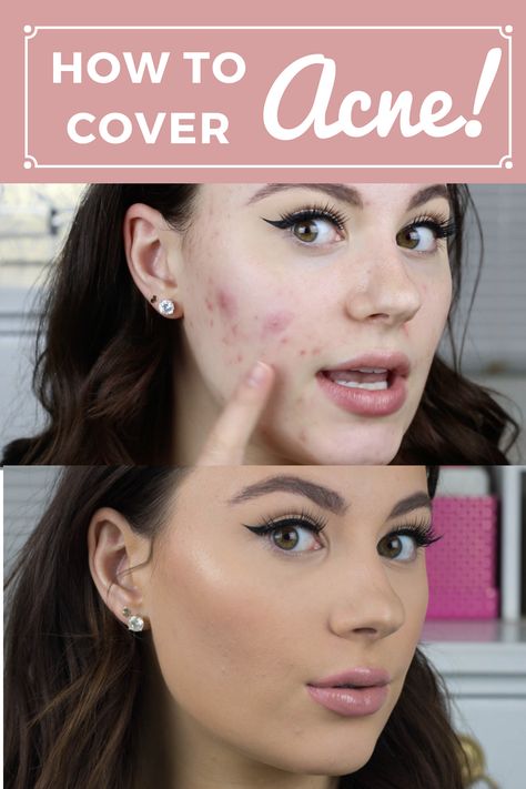 Covering Up Acne With Makeup, Makeup Hacks To Cover Acne, Best Way To Cover Acne With Makeup, How To Conceal Acne, Hiding Acne With Makeup, How To Cover Acne With Concealer, How To Cover Spots With Makeup, Make Up With Acne Skin, How To Cover Cystic Acne With Makeup