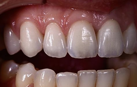 Canine Teeth Human, Canine Teeth Human Aesthetic, Dental Morphology, Teeth Reference, Human Aesthetic, Dental Ceramics, Canine Teeth, Dental Images, Dental Photography