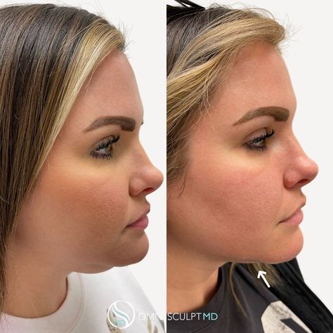 View Our Kybella Before & After Gallery | OMNI SCULPT MD Double Chin Before And After, Kybella Before And After Double Chin, Kybella Before And After, Double Chin, Cosmetology, Round Face, Dallas Tx, Contact Us, Dallas