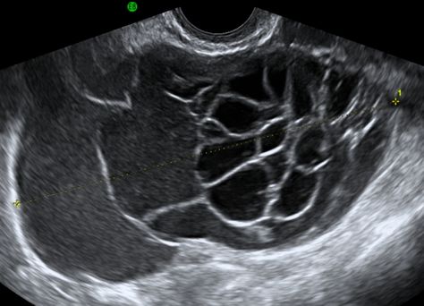 Ovarian mucinous cystadenoma Diagnostic Sonography, Ultrasound Anatomy, Gyn Ultrasound, Obstetric Ultrasound, Vascular Ultrasound, Radiologic Technology, Ultrasound Sonography, Medical Ultrasound, Diagnostic Medical Sonography