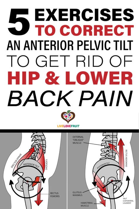 graphic anatomical representation of anterior pelvic tilt with text - 5 exercises to correct an anterior pelvic tilt to get rid of hip & lower back pain Anterior Pelvic Tilt, K Tape, Hip Flexor Exercises, Hip Pain Relief, Back Stretches For Pain, Pelvic Tilt, Lower Back Pain Exercises, Posture Exercises, Relieve Back Pain