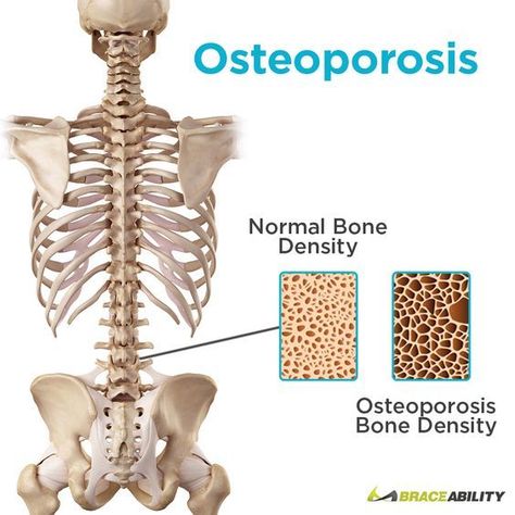 What is osteoporosis? Osteoporosis is a type of bone disease that occurs when the body loses too much bone or makes too little of bone. This condition commonly occurs to women over the ages of 50. Learn 9 underlying factors that may lead to osteoporosis & how to treat it! | BraceAbility Osteoporosis Symptoms, Osteoporosis Exercises, Anatomy Bones, Spine Pain, Bone Diseases, Skeletal System, Musculoskeletal System, Spine Health, Biology Notes