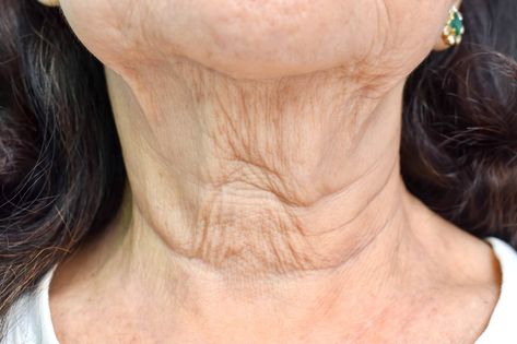 Woman Front View, Reduce Neck Wrinkles, Skin Folds, Elderly Woman, Neck Wrinkles, Crepey Skin, Dark Circles Under Eyes, Laser Therapy, Chemical Peel