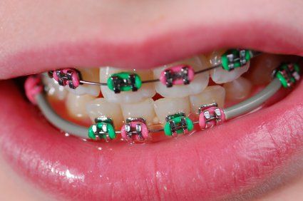 Recipes for people with braces ~ Recipes for after mouth surgery | HubPages Braces Recipes, Soft Foods After Surgery, Soft Foods After Surgery Teeth, People With Braces, Braces Friendly Recipes, Pink Braces, Braces Food, After Wisdom Teeth Removal, Kids Braces