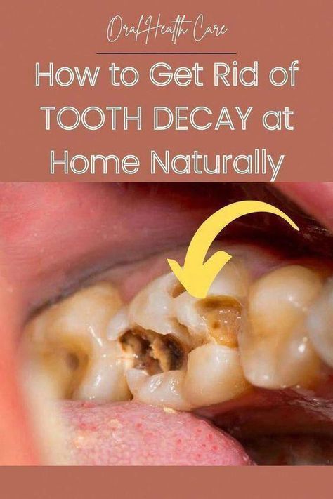 Remove Plaque From Your Teeth and Also Remove Tooth Decay and Cavities Naturally At Home #WhatsOralCare #HowIsOralCareDone #WhatAreOralCare #WhatDoesOralCareMean Tooth Decay Remedies, Dental Cavities, Teeth Health, Gum Care, Receding Gums, Oral Care Routine, Natural Teeth, Healthy Smile, Oral Health Care