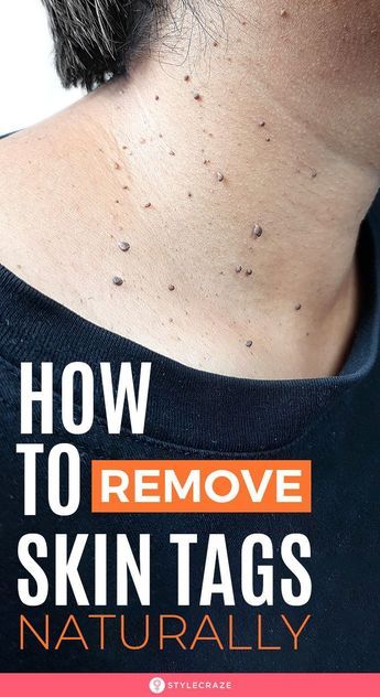 Remove Skin Tags, Remove Skin Tags Naturally, Home Remedies For Skin, Skin Tags, Cold Sores Remedies, Natural Sleep Remedies, Natural Cold Remedies, Glow Skin, Natural Cough Remedies