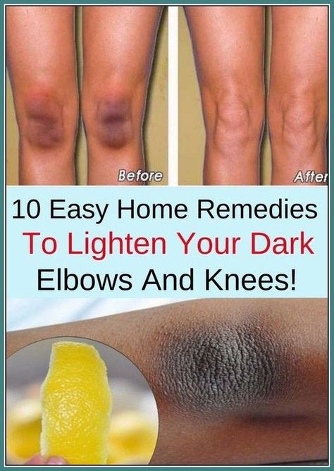 DIY remedies for dark underarms How To Lighten Knees, Remedies For Dark Underarms, Dark Elbows And Knees, For Dark Underarms, Dark Spots On Legs, Sunburn Peeling, Dark Elbows, Constant Headaches, Natural Face Care