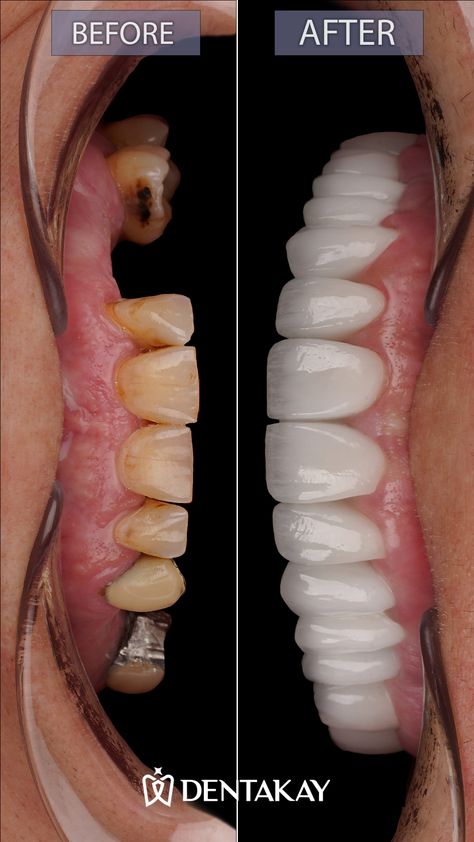 Wondering how long does a dental implant take? Read more on our Website. Dental Photography Photo Ideas, Exocad Dental, Best Hd Pics, Tooth Implant, Dental Smile, Dental Advertising, Dental Photos, Office Productivity, Implant Dentist