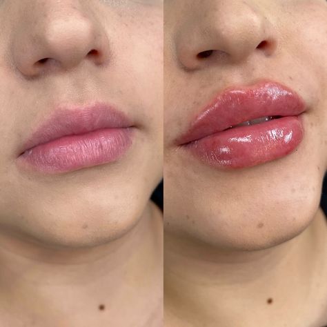 Lip Filler Before And After 1ml, 1 Ml Lip Filler, Skin Anatomy, Lips Inspiration, Face Fillers, Wax Roller, Botox Lips, Eyebrow Makeup Tutorial, Botox Face